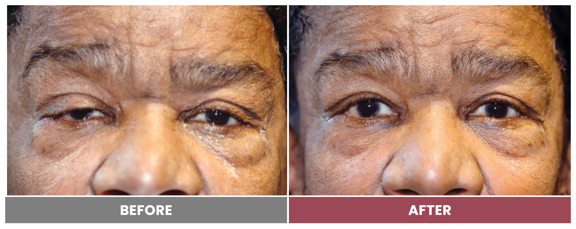 PTOSIS REPAIR - Case 19